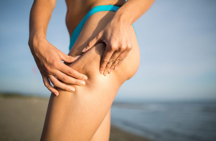 cellulite