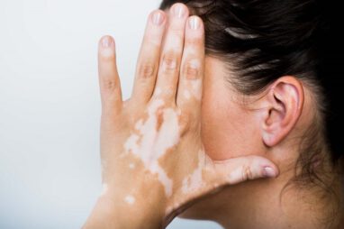 vitiligo