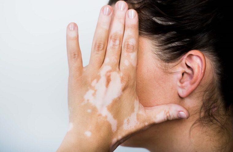 vitiligo