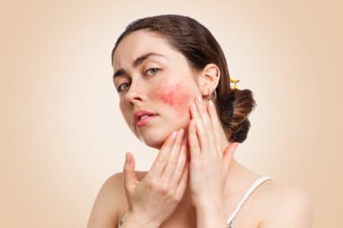 couperose-en-rosacea
