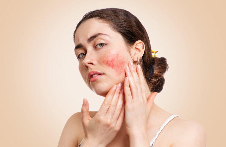 couperose-en-rosacea