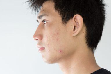 acne