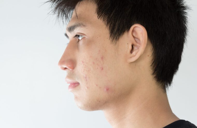 acne
