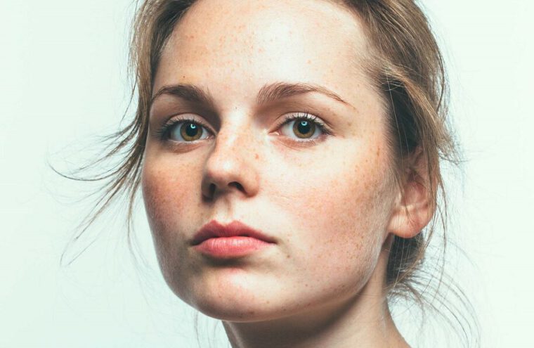rosacea
