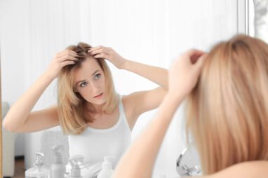 alopecia