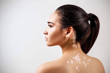 dermatografie