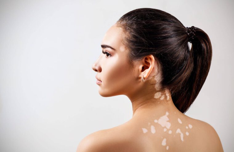 dermatografie