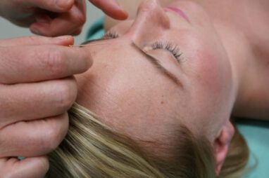 acupunctuur