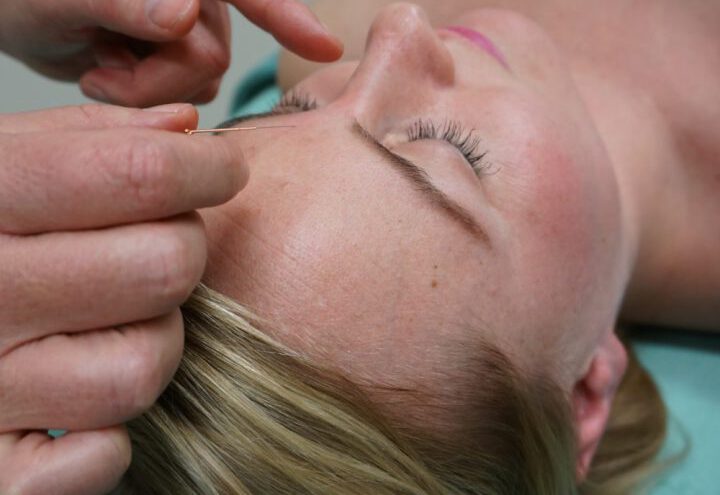acupunctuur