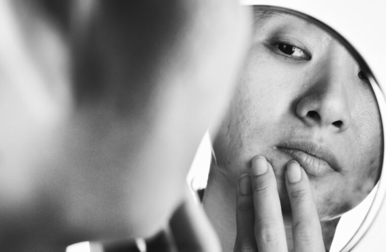 acnelittekens