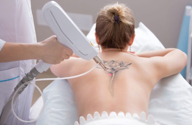 tattoo-verwijdering
