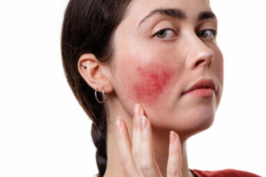 rosacea
