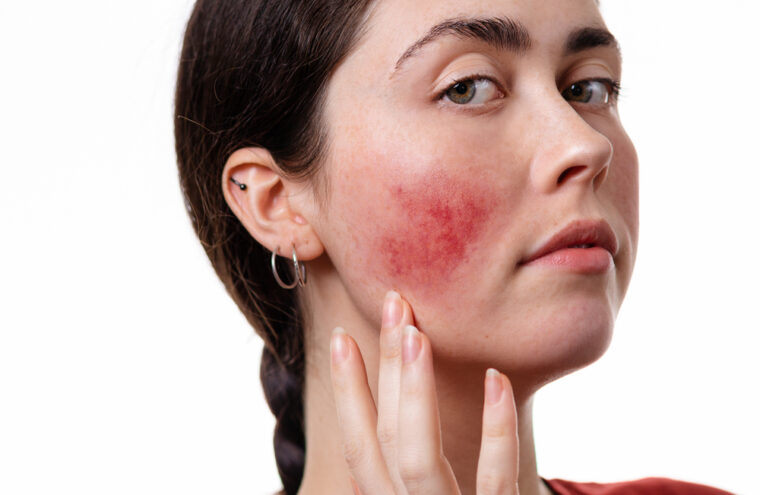 rosacea